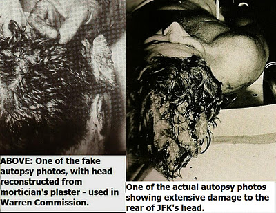 JFK-autopsy